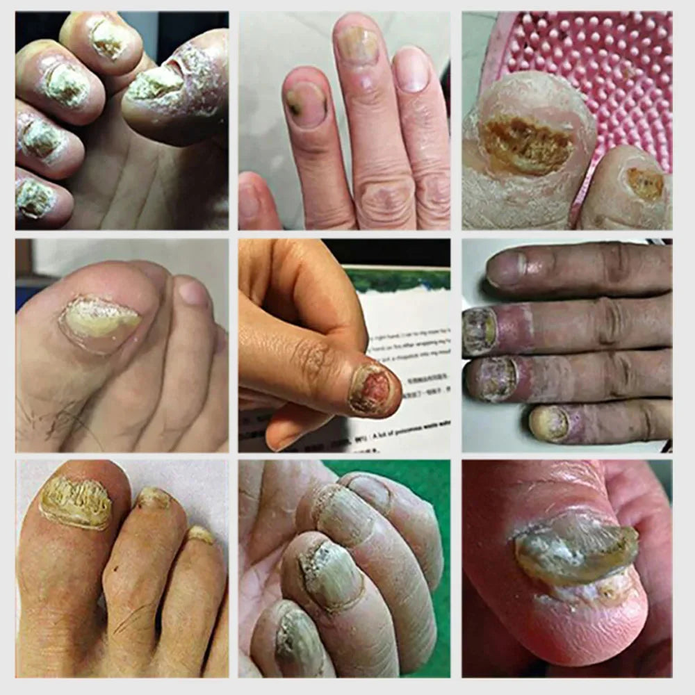Nail Fungus Treatment Serum