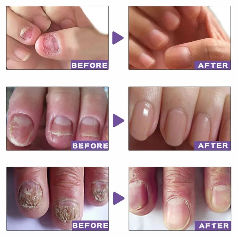 Nail Fungus Treatment Serum