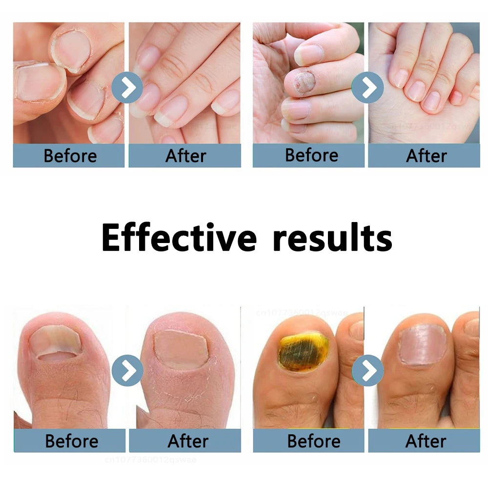 Nail Fungus Treatment Light Device