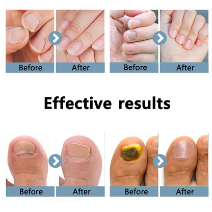 Nail Fungus Treatment Light Device